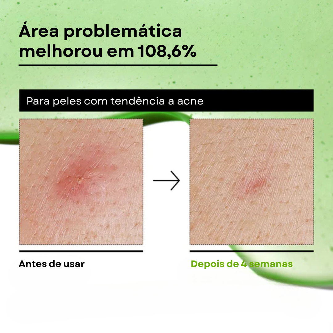 Sérum Ácido Azelaico 10% para Vermelhidão e Acne | Anua