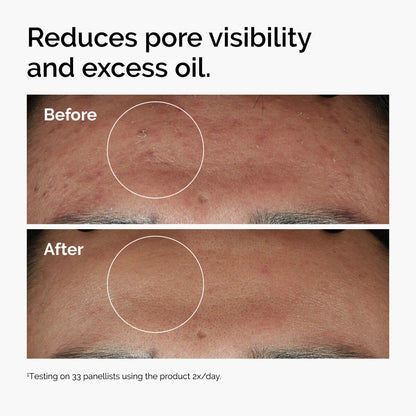 The Ordinary Niacinamide serum for enlarged pores